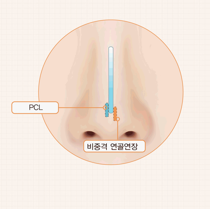 메쉬코성형