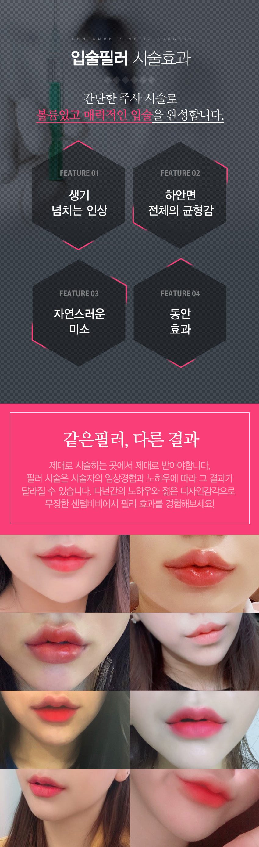 입꼬리필러