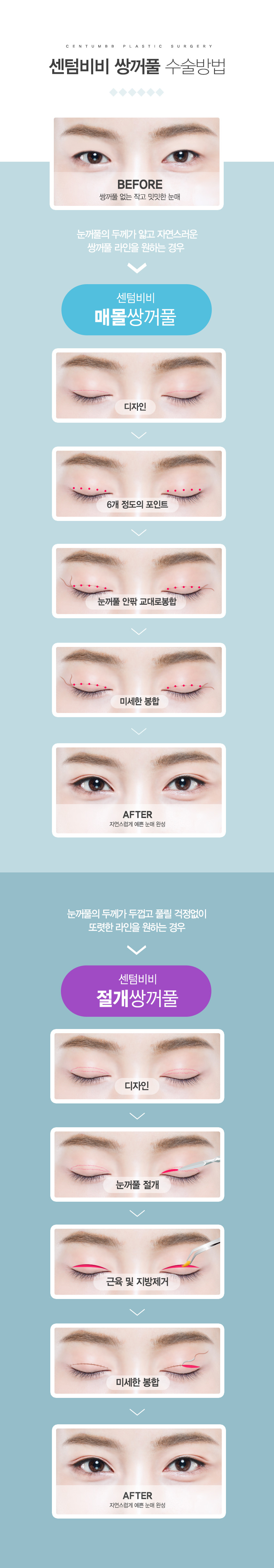 쌍꺼풀