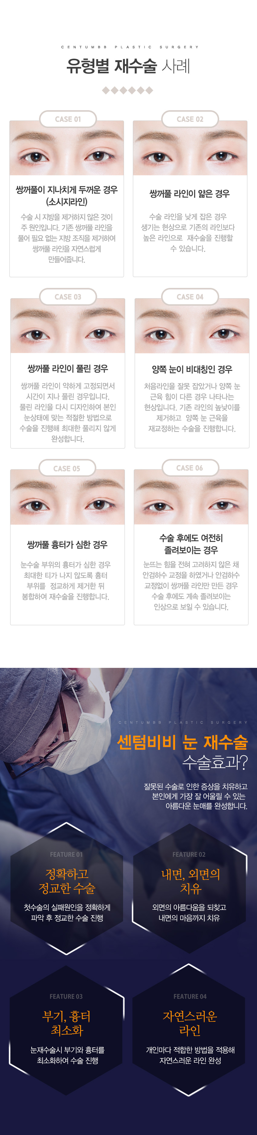 눈재수술