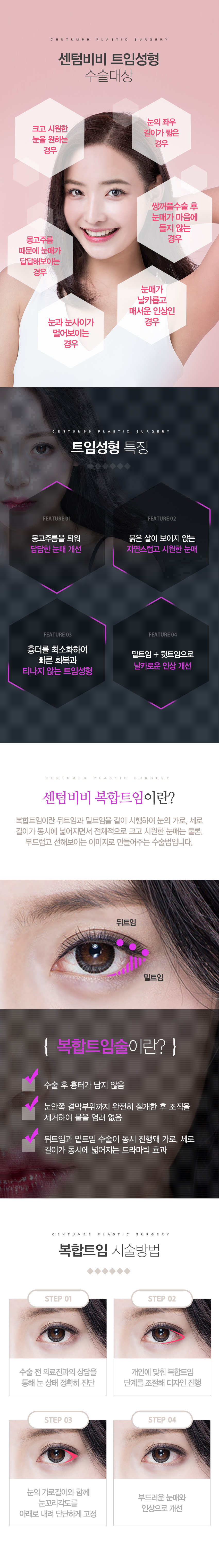 트임성형