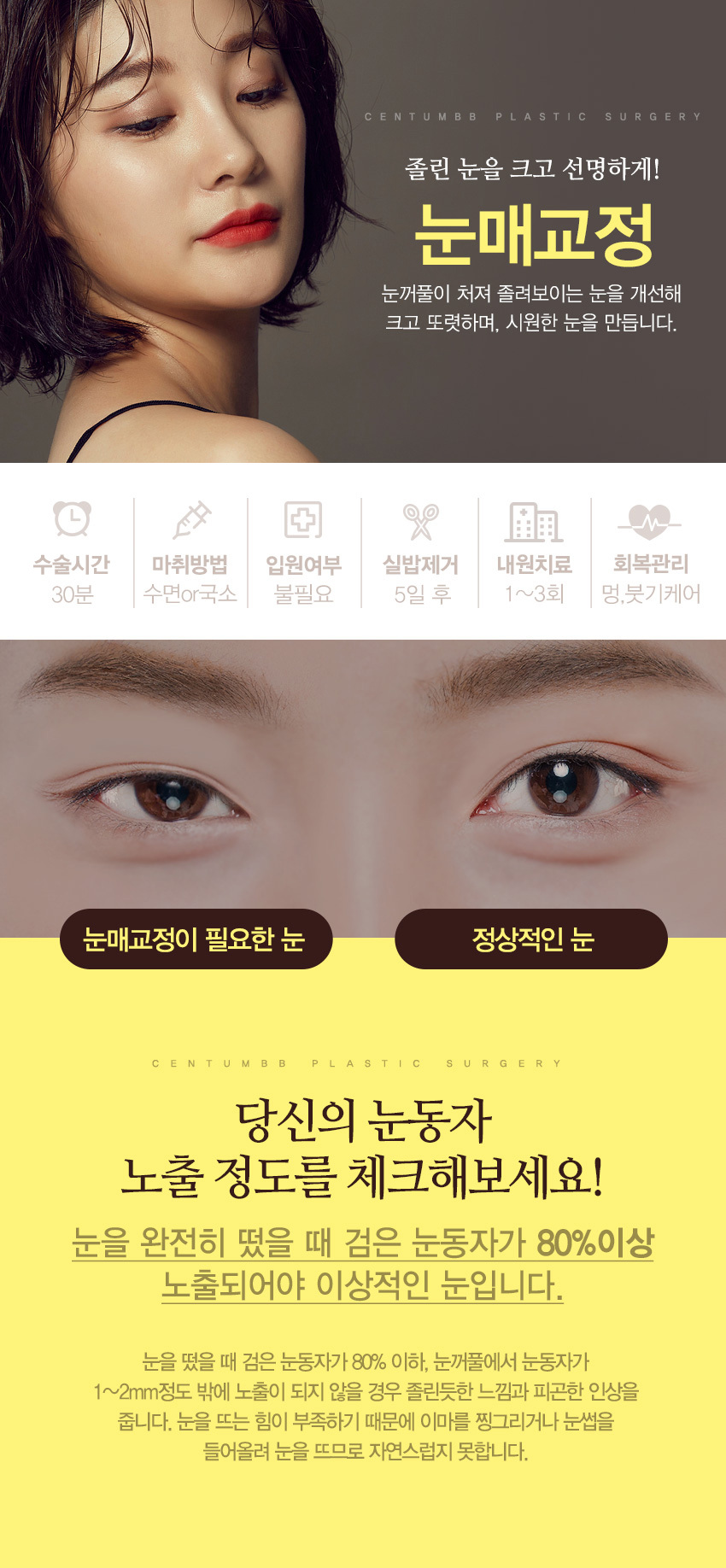 눈매교정