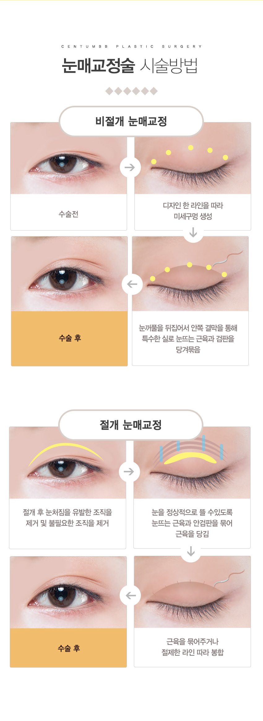 눈매교정