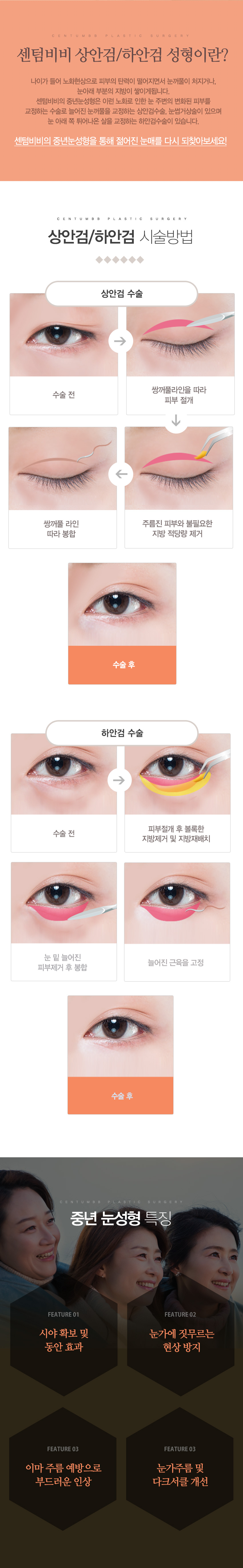 상/하안검