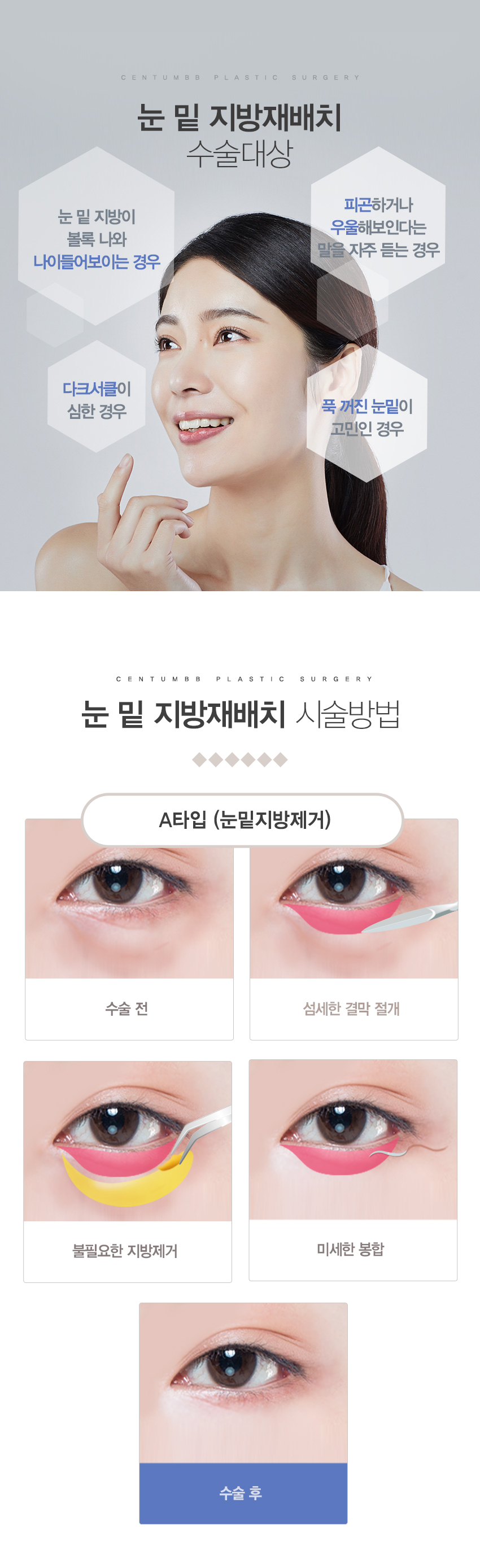 눈밑지방재배치