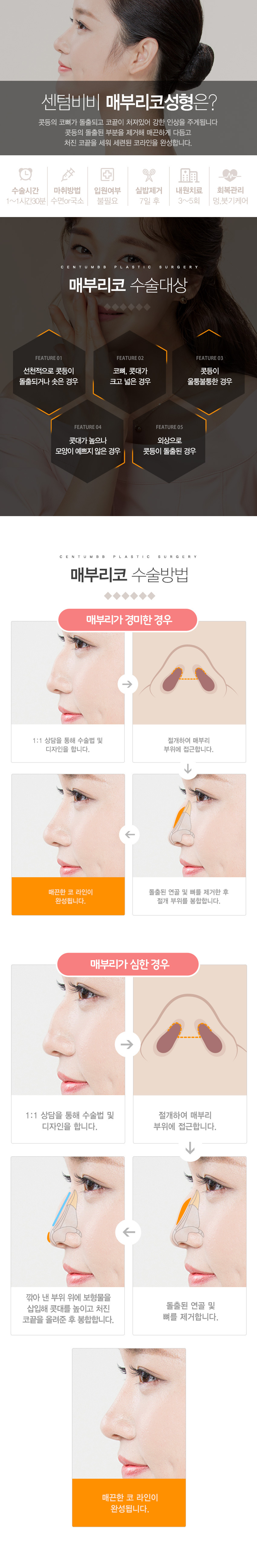 매부리코