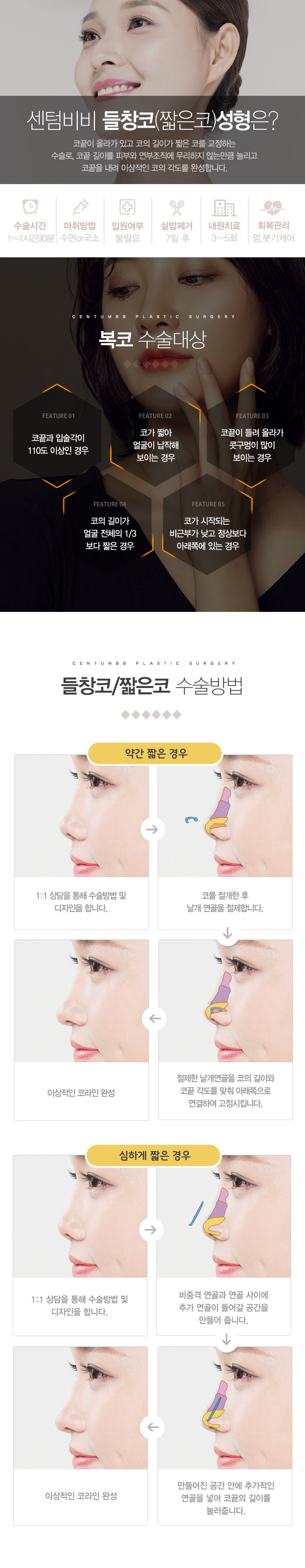 들창코(짧은코)