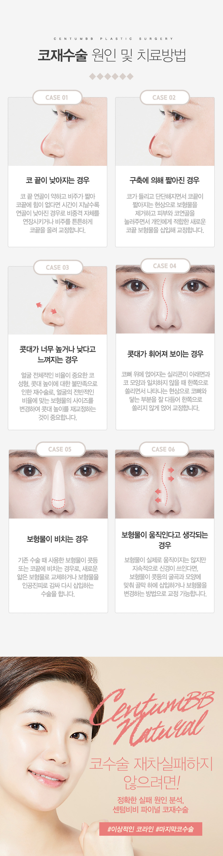 파이널코재수술