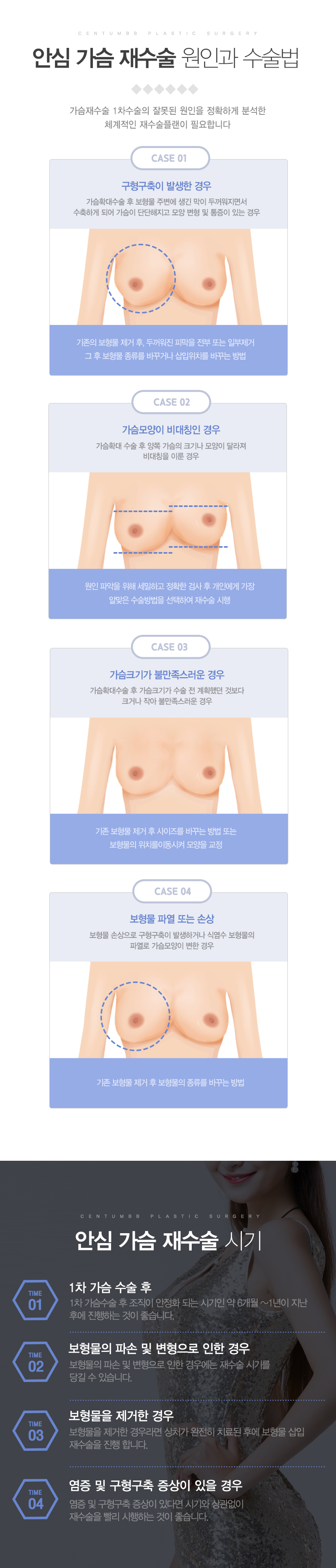 가슴재수술