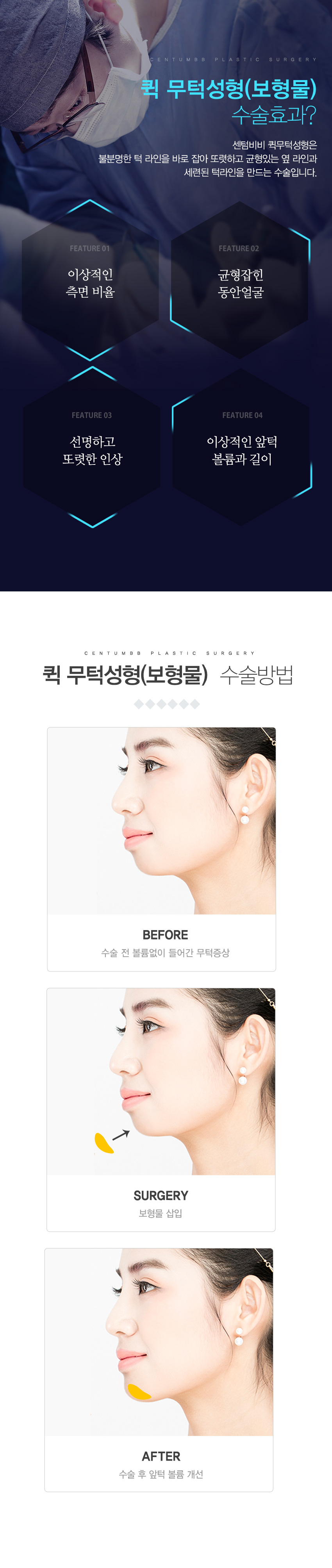 퀵 무턱수술