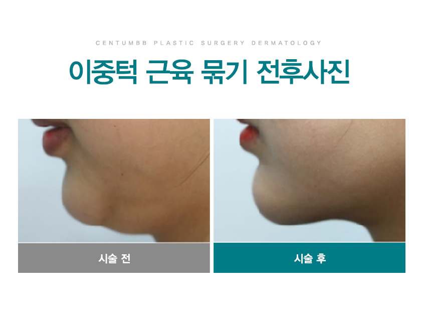 이중턱 근육 묶기