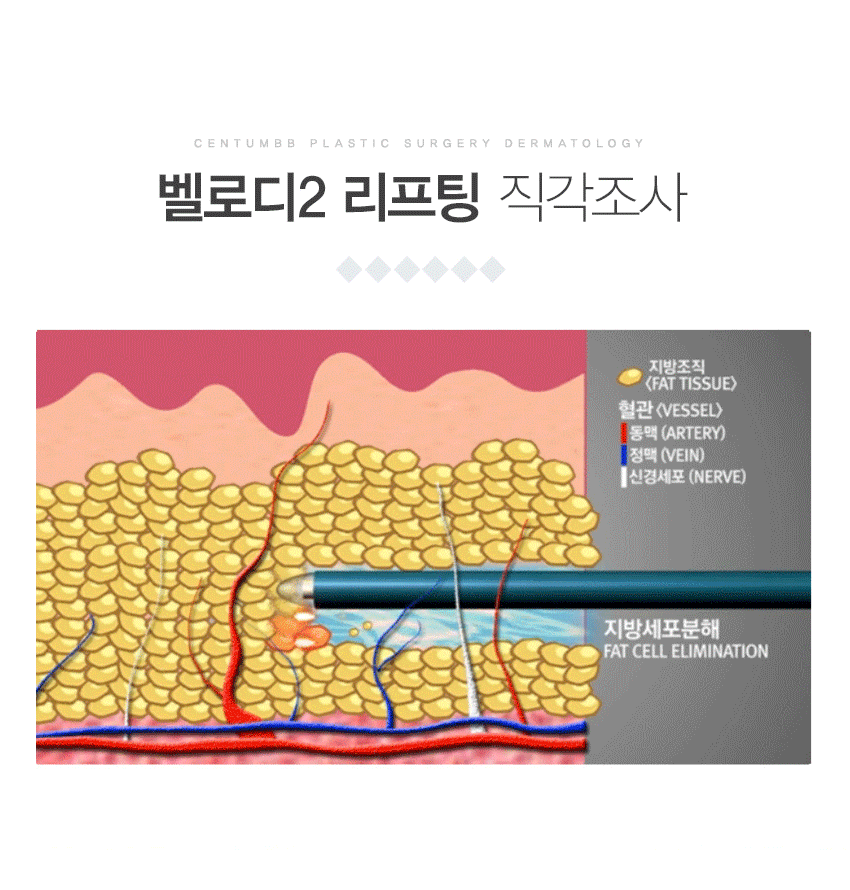 벨로디2리프팅